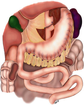 <p>Schematic of Gastric Bypass Using a Roux-en-Y Anastomosis