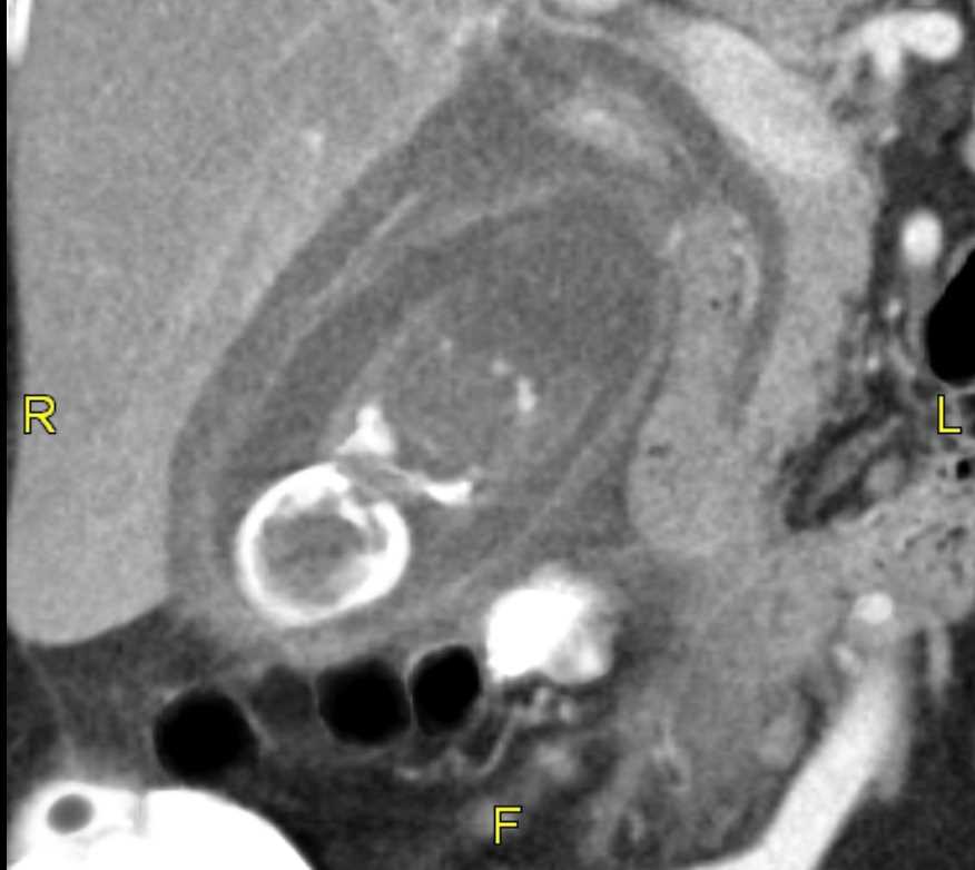 <p>Axial CT Abdomen Acute Cholecystitis.</p>