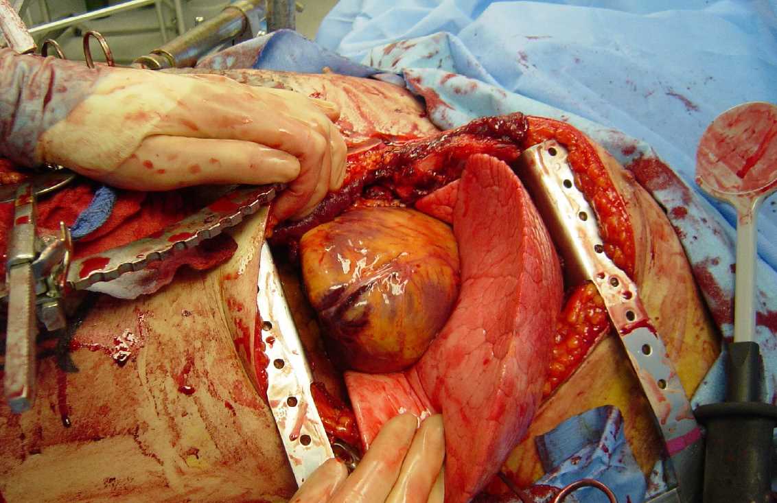 <p>Emergency Department Thoracotomy Clinical Field