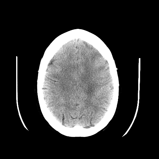 <p>Peripheral&nbsp;Artifact on Head Computed Tomography