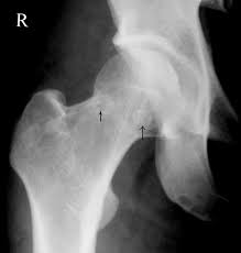 <p>Dysbaric Osteonecrosis of the Hip.</p>