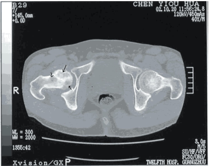 <p>Dysbaric Osteonecrosis, Computed Tomography</p>