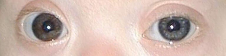 <p>Eyes of an Infant With Down Syndrome