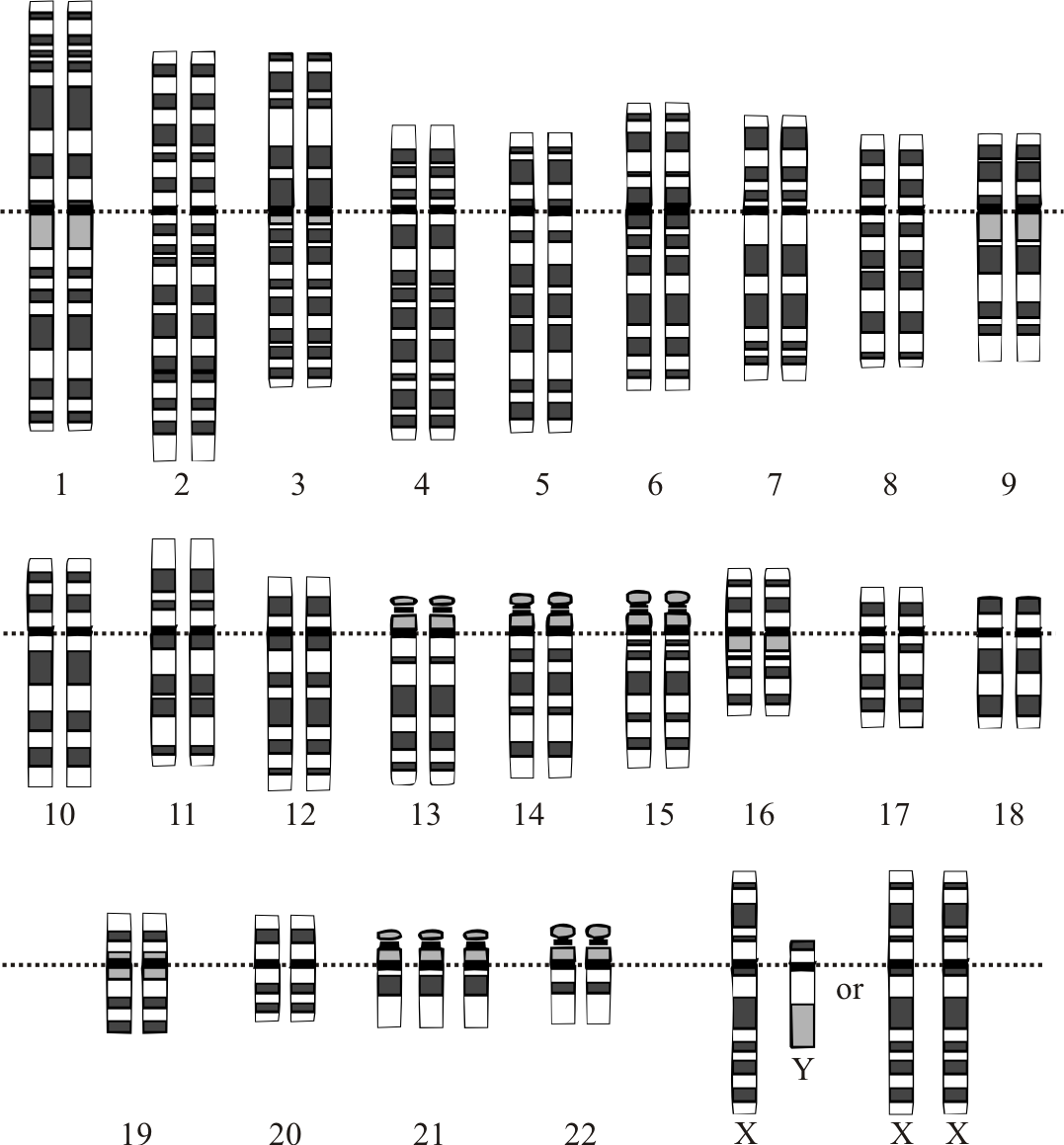 <p>Karyotype of Down Syndrome (Trisomy 21)