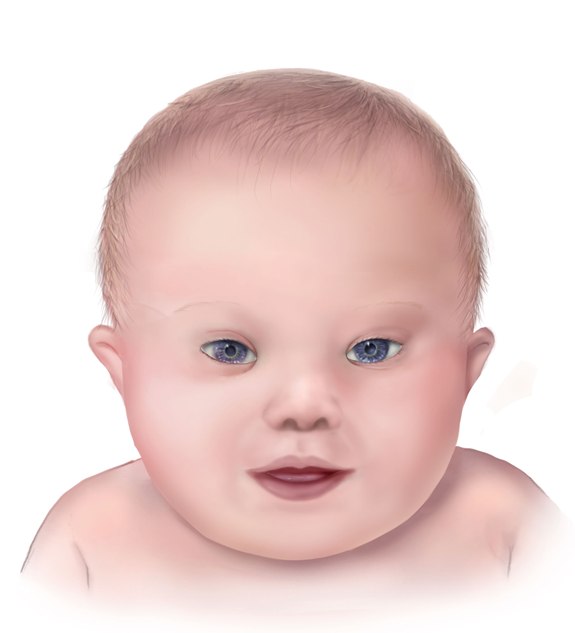 <p>Facial Features of a Child With Down Syndrome