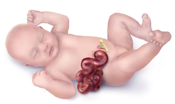 <p>Gastroschisis. Illustration of a baby with gastroschisis.</p>
