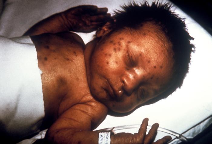 <p>Congenital Rubella. This image demonstrates the blueberry muffin-like skin lesions indicative of congenital rubella.</p>