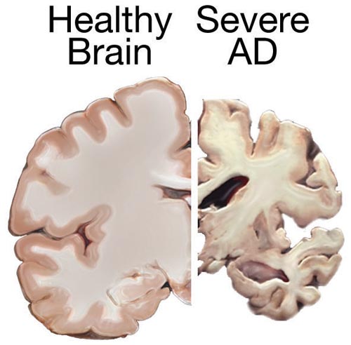 <p>Health Versus AD Brain