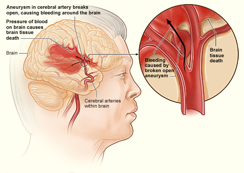 <p>Hemorrhagic Stroke Process
