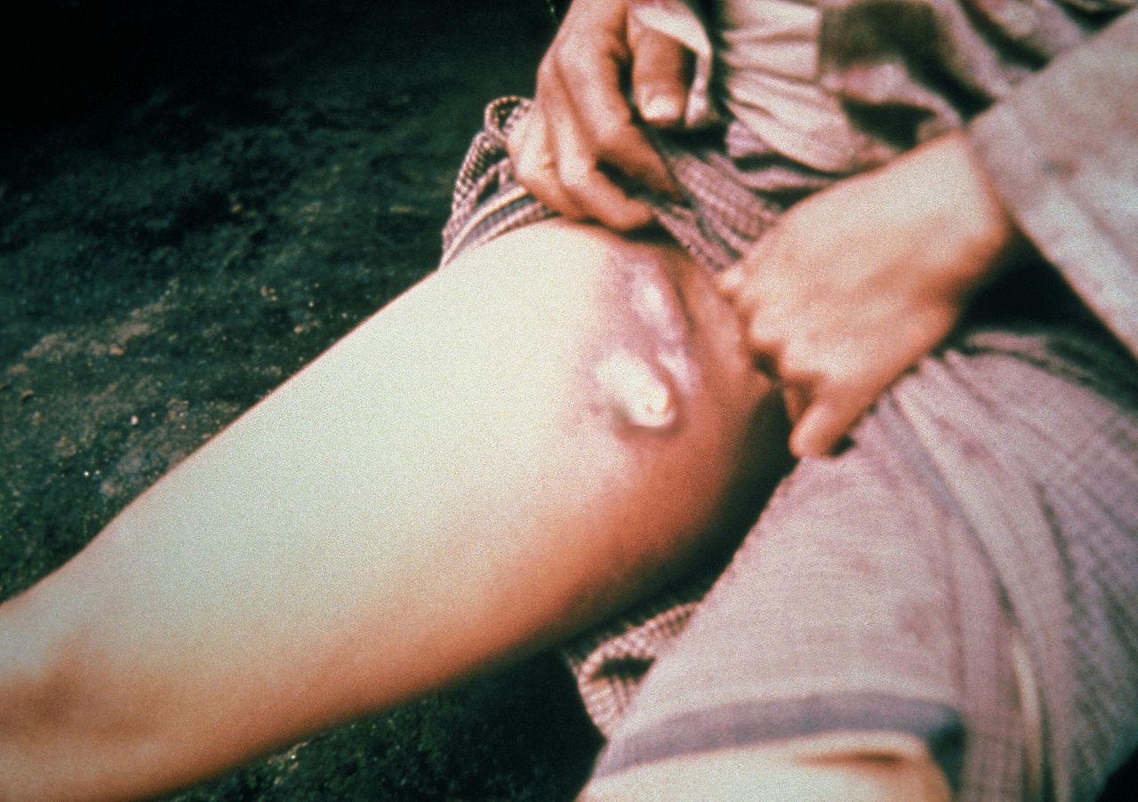 <p>Suppurative Inguinal Lymphadenopathy (Bubo) Secondary to <em>Yersinia pestis</em> Infection