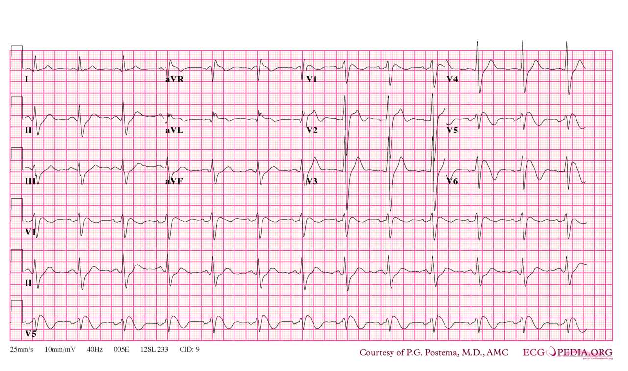 <p>Brugada Syndrome Type 1 Morphology