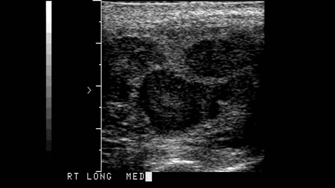 <p>Ultrasound of Seminoma of the Testicle.</p>