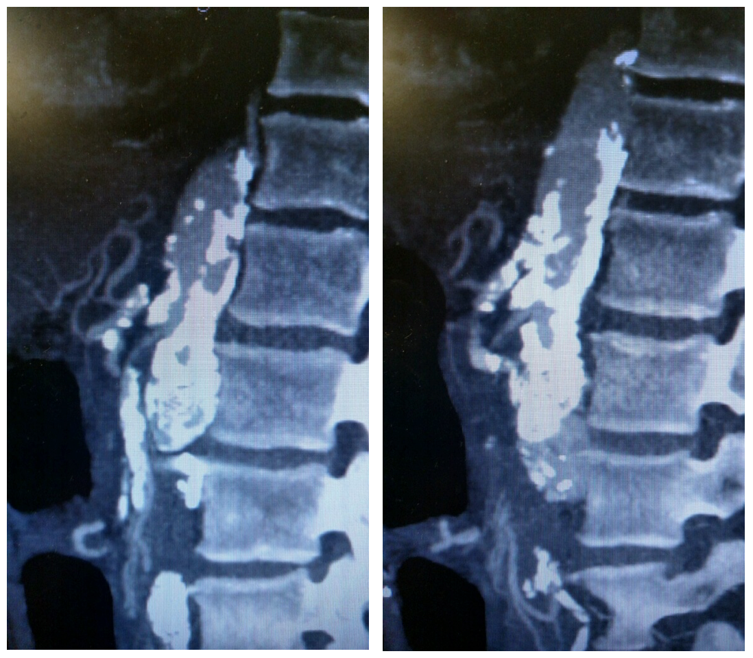 <p>CT Angiogram of the Superior Mesenteric Artery