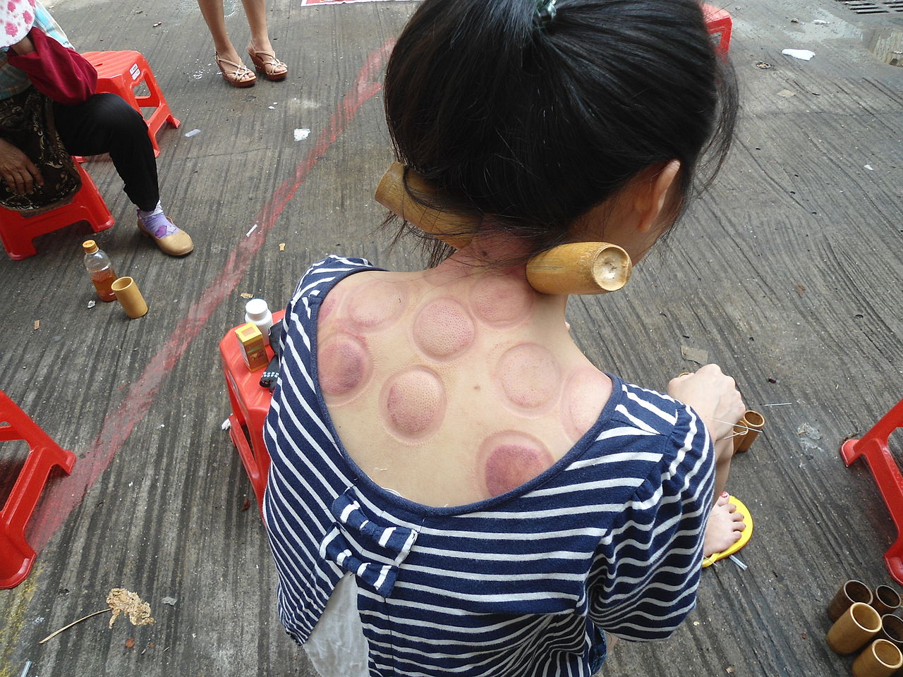 <p>Fire Cupping.</p>