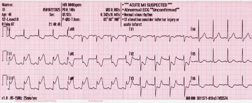 <p>Electrocardiogram With Pardee Waves