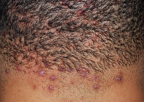 <p>Acne Keloidalis Nuchae, Follicular-Based Papules, Pustules.</p>