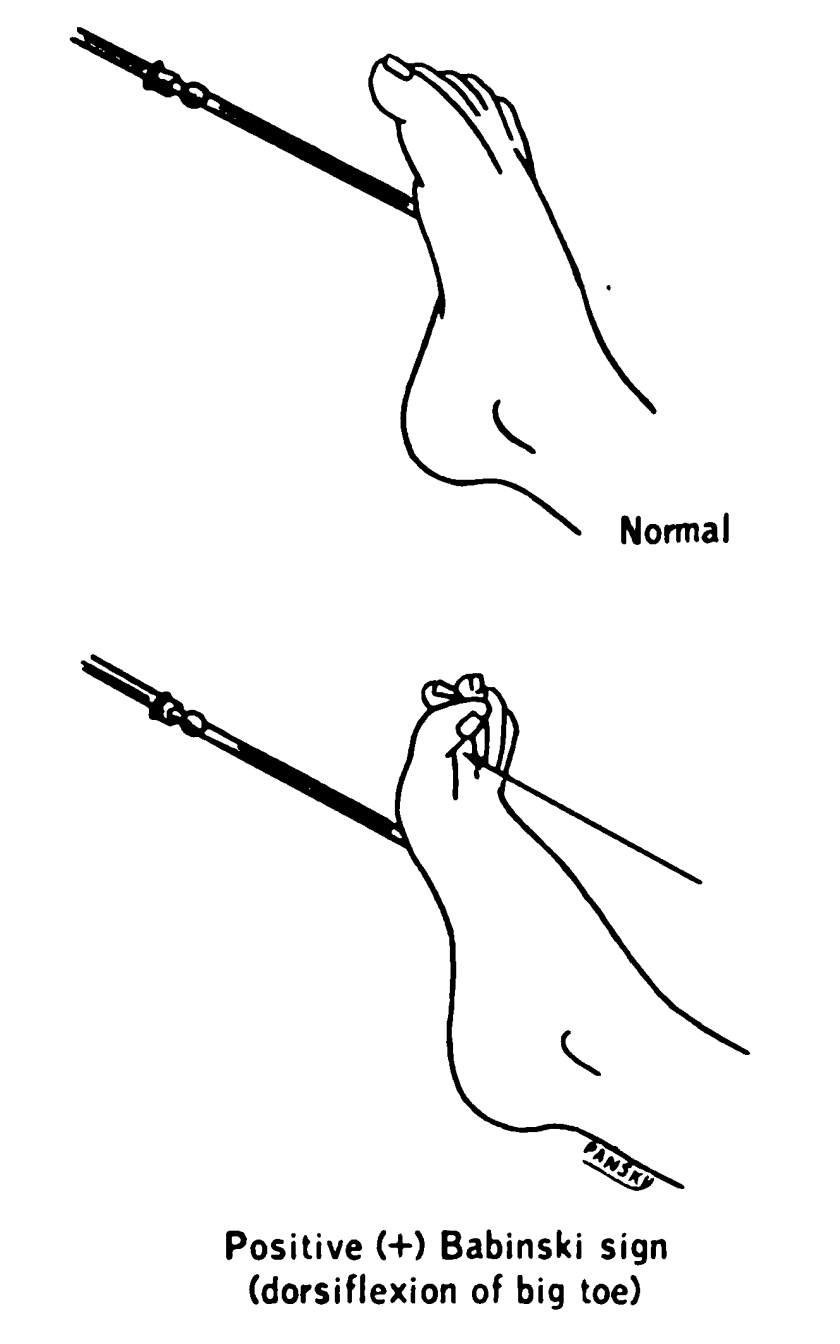 <p>Babinski Reflex