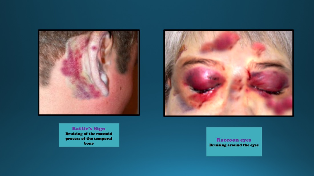 <p>Basilar Skull Fracture