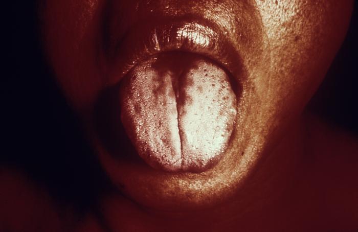 <p>Atrophic Glossitis: Atrophy of Filiform Taste Bud