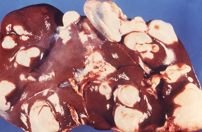 <p>Hepatic Echinococcosis, Sheep's Liver