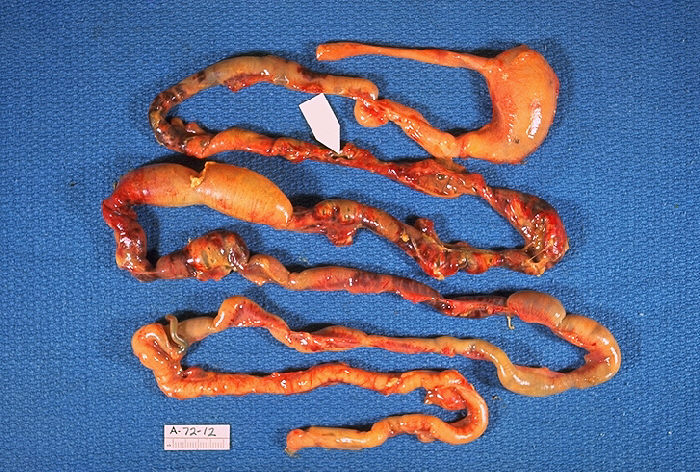<p>Neonatal Necrotizing Enterocolitis With Intestinal Perforation