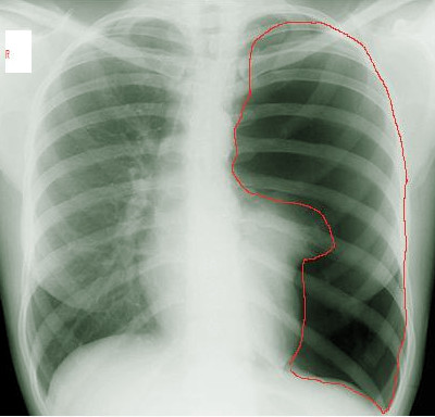 <p>Left Pneumothorax on Radiography