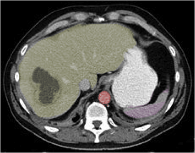 <p>Hepatic Abscess, Computed Tomography (CT)