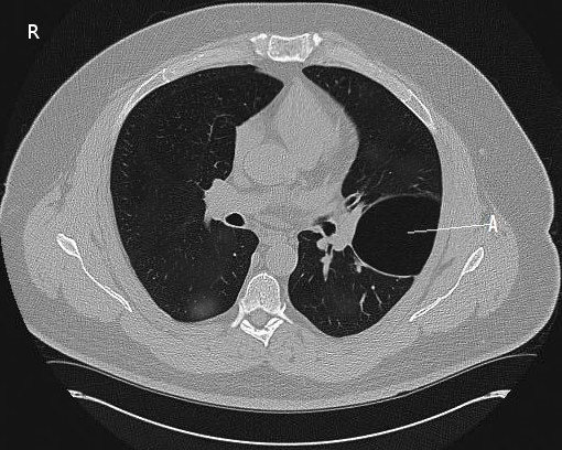 <p>Pulmonary Bulla on Computed Tomography
