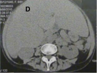 <p>Systemic AL Amyloidosis, Pathology, Voluminous Hepatomegaly due to primary hepatic amyloidosis, Liver, CT scan</p>