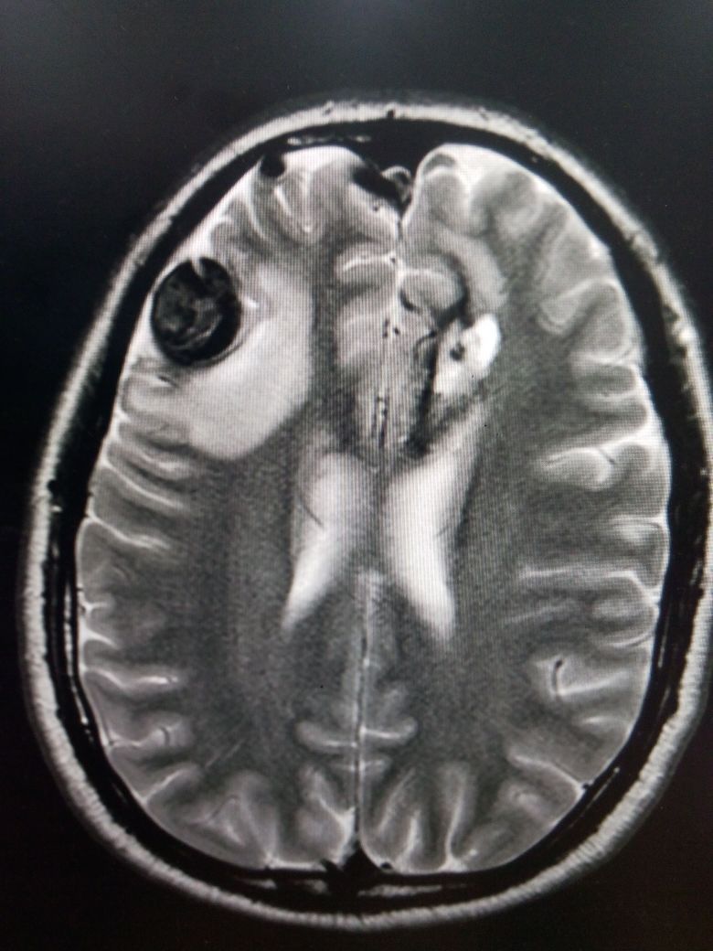 <p>Arteriovenous Malformation With Aneurysm and Intraparenchymal Bleeding