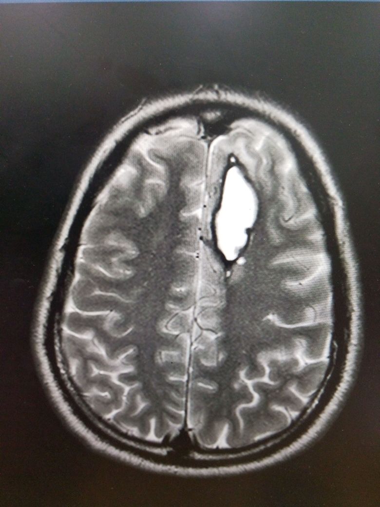 <p>Aneurysm Formation and Intraparenchymal Bleed