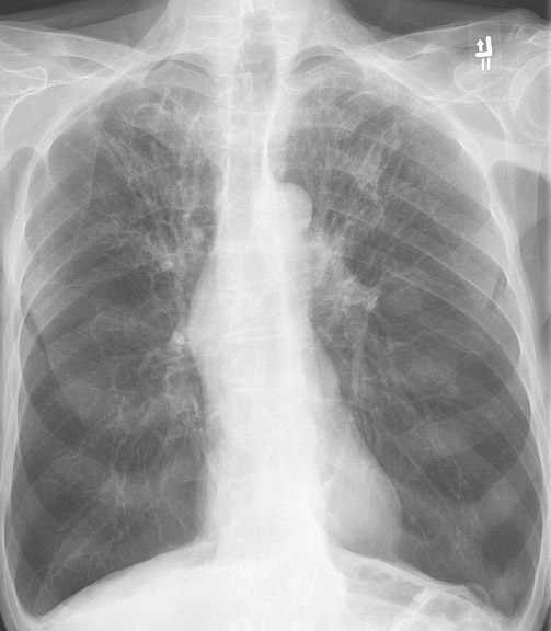 <p>Chronic Obstructive Pulmonary Disease, Chest Radiograph