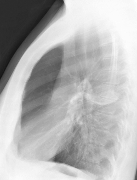<p>Chronic Obstructive Pulmonary Disease, Right Upper Lobe, Bulla, Lateral Chest Radiograph.</p>