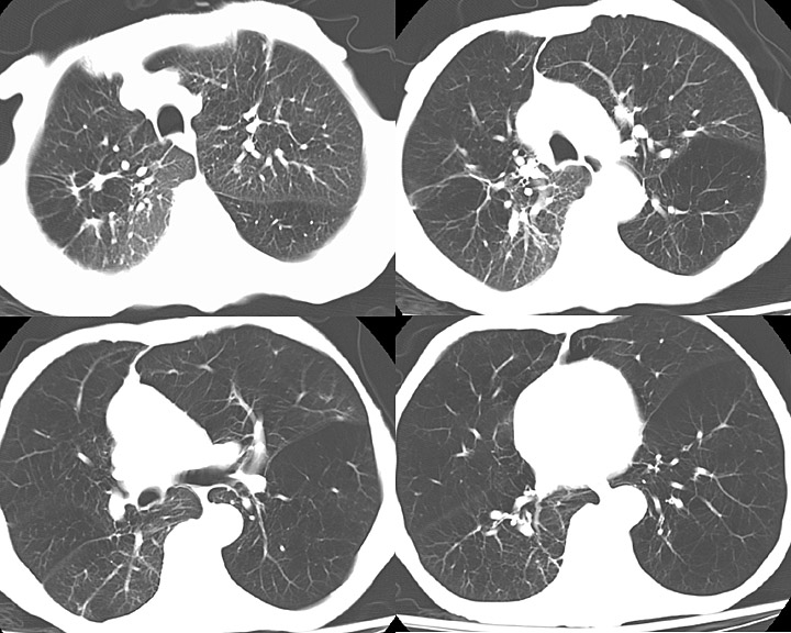 <p>Chronic Obstructive Pulmonary Disease, Left Lung Computed Tomography Scan.</p>