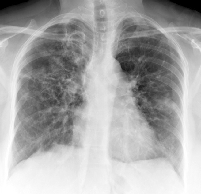 <p>Chronic Obstructive Pulmonary Disease and Allergic Bronchopulmonary Aspergillosis