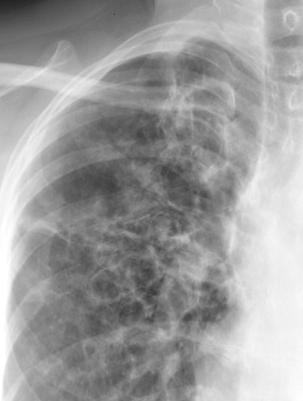 <p>COPD and ABPA X-Ray. Close-up view of a posterior-anterior view of a patient with COPD and ABPA.</p>