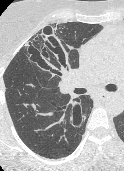 <p>Central Bronchiectasis