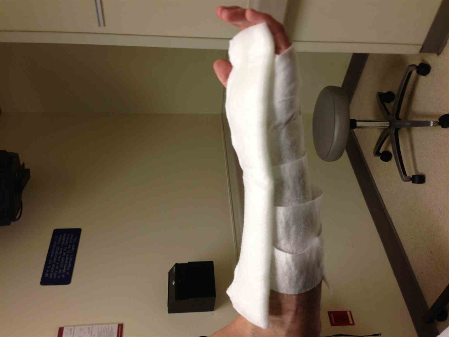 <p>Volar Splint Side View.</p>
