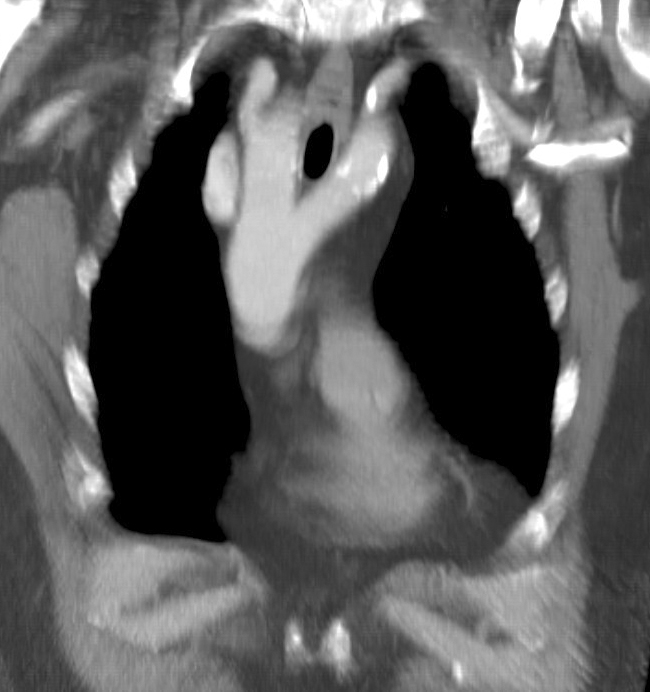 <p>Cardiac Computed Tomography, Double Aortic Arch.</p>