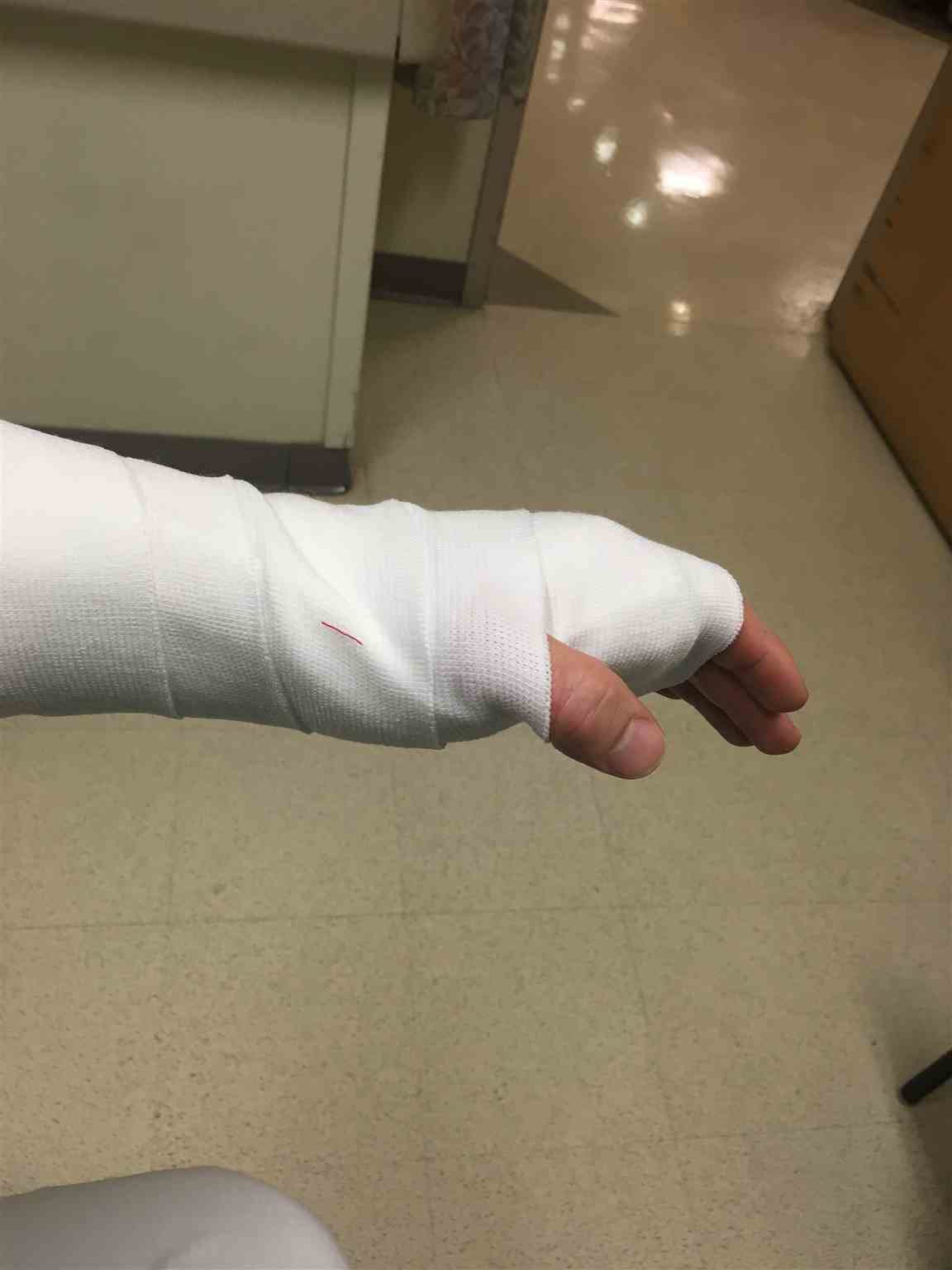 <p>Completed Volar Splint.</p>