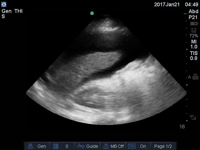 <p>Abdominal Ascites. Ultrasound image showing abdominal ascites.</p>