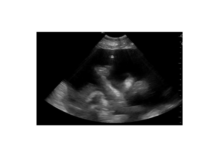 <p>Paracentesis