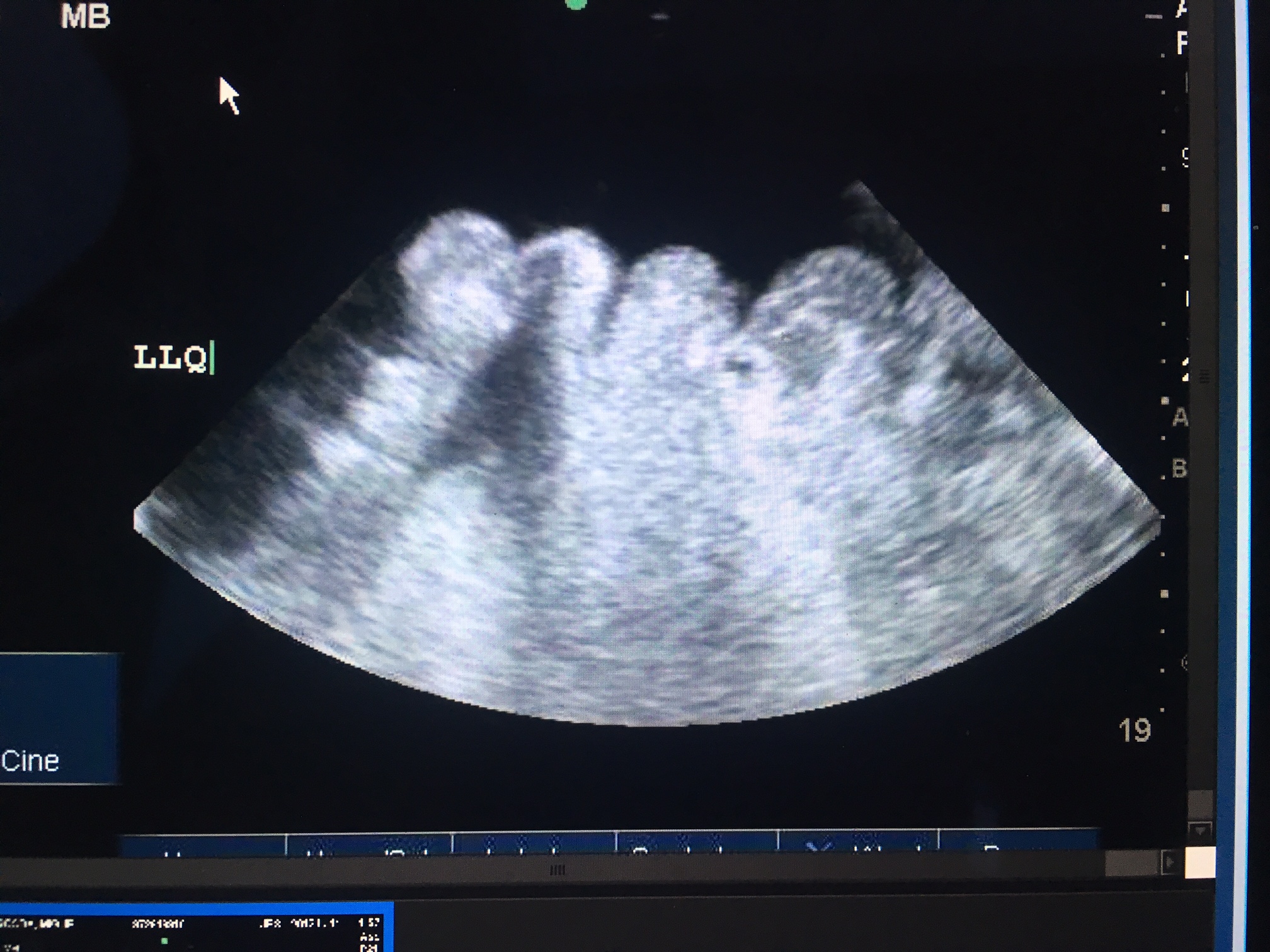 <p>Ascites Pocket. Image demonstrating a pocket of ascites ideal for paracentesis.</p>
