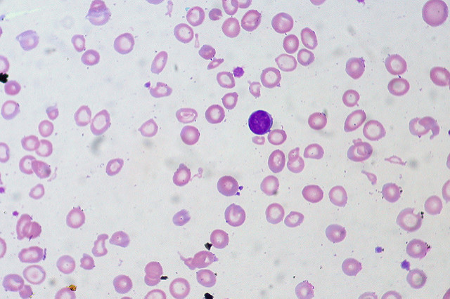 <p>Iron Deficiency Anemia