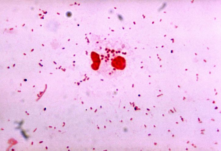 <p>Gonorrhea Gram Stain. Image of gonorrhea diplococcus on a Gram stain.</p>