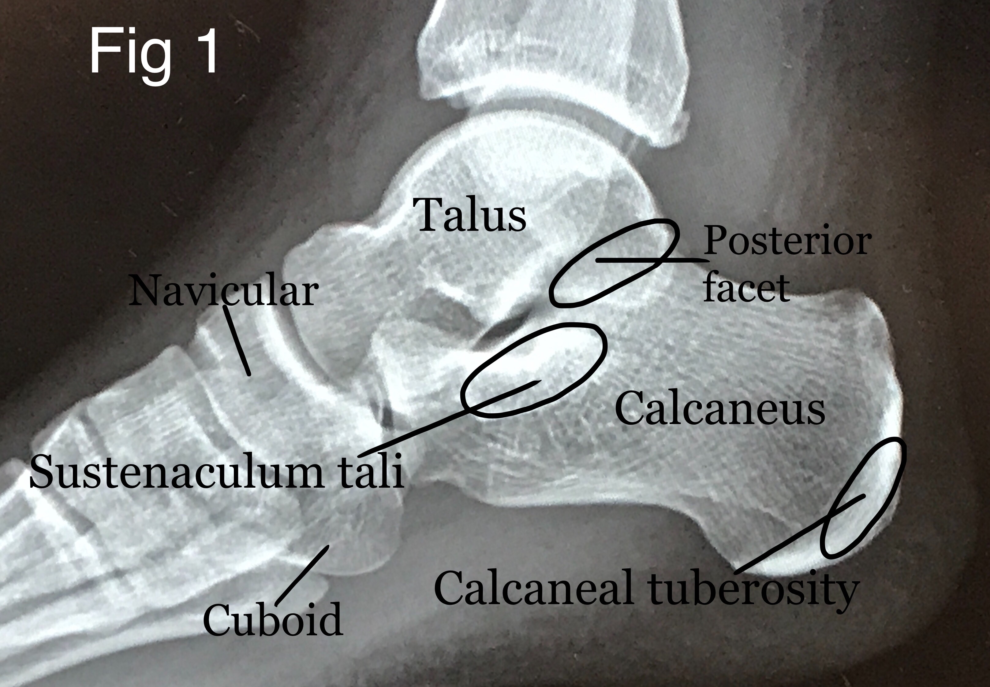<p>Labeled Lateral Radiograph of the Hindfoot and Midfoot Bones