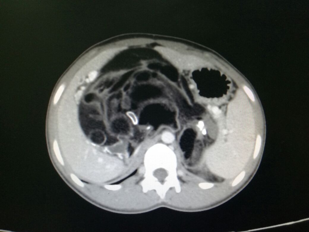 <p>Adrenal Myelolipoma