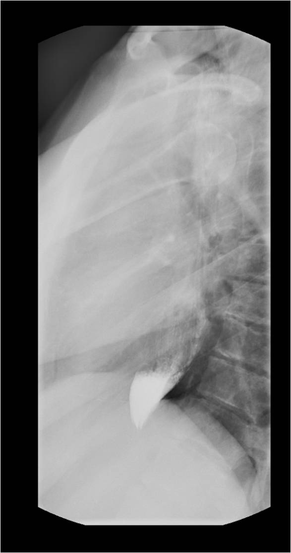 <p>Achalasia. Diagnostic imaging demonstrating beak-like narrowing of the distal esophagus with proximal distension.</p>