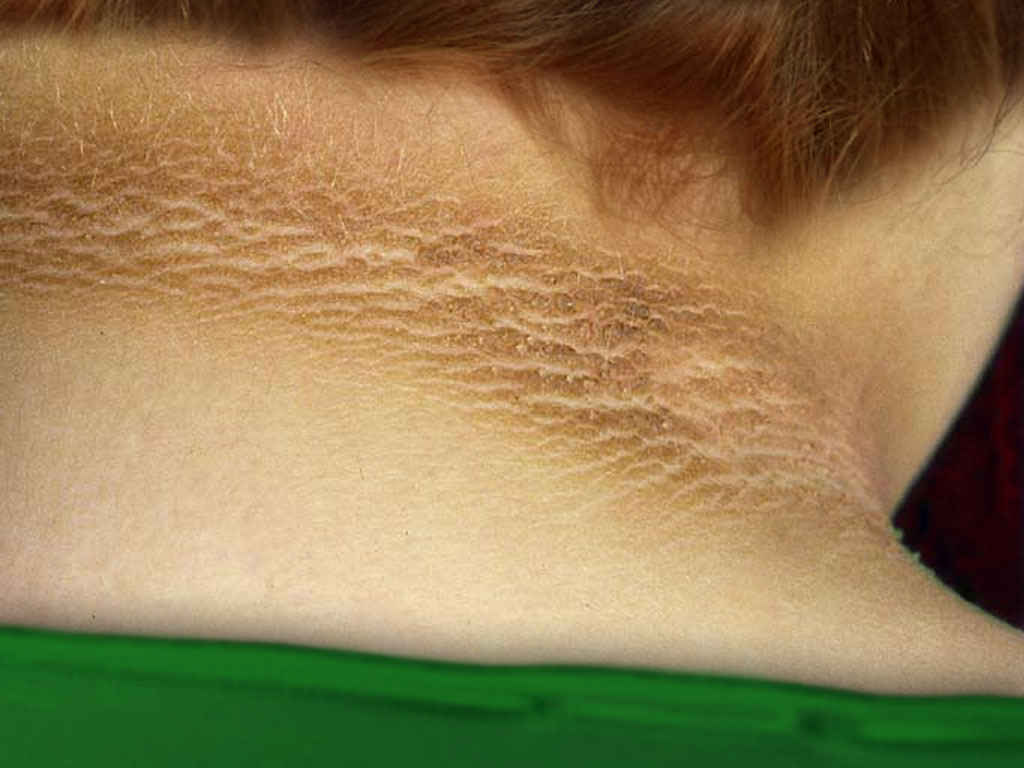 <p>Acanthosis Nigricans.</p>