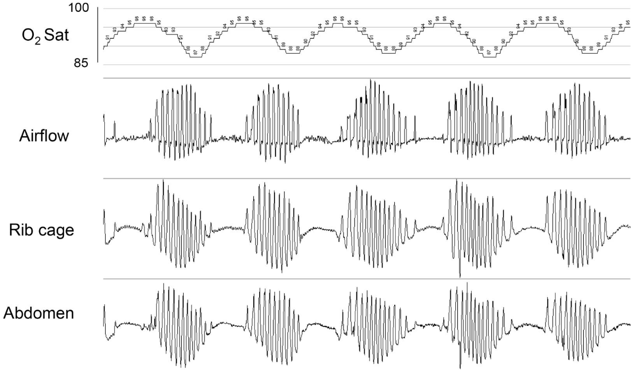 <p>Polysomnography of Cheyne-Stokes Respiration